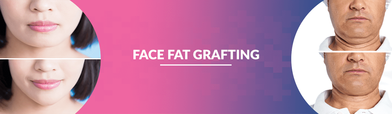 FACE-FAT-GRAFTING