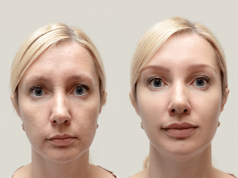 Facial Rejuvenation-women